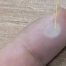 티엔피부과의원 | 사마귀 치료제 베루말 사용 후기