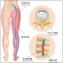 허리편한신경외과의원 | 창원신경외과병원, 허리디스크 비수술적 치료방법 2가지에 대해