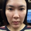 39살 여러가지 피부과 시술들후기(스컬트라, 텐써마, 앞볼필러, 실리프팅, 온다리프팅, 스킨부스터 등)