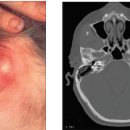 비화농성 중이염[non-suppurative otitis media] 이미지