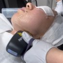 킬로커스텀 | [압구정피부과] 결혼식전 티타늄리프팅 80kJ 솔직후기! 비대칭, 심부볼 고민 해결한 결혼식전관리
