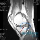 [무릎통증] 다치기 쉬운 반월상연골판 이미지