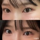 홍익약국 | [홍대피부과]홍대필러 자연스러운 애교살필러 내돈내산 후기