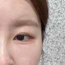 클리어레이저 | 청량리 피부과 레이저계의 에르메스 피부 턴오버 끝판왕 울트라 클리어 레이저 솔직후기