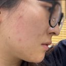 아그네스 | 수원 압출 아그네스 통증 후기 내돈내산