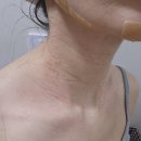 오름약국 | 편평사마귀 레이저 1일차~7일차 후기입니다!!