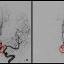 두통인줄 알고 넘겼는데..머릿속 시한폭탄..뇌동맥류 판정. 이미지
