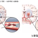 뇌졸중 이미지