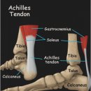 달서연합정형외과의원 | 달서구 아킬레스건 정형외과 파열 증상과 치료과정은?