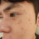 분당분당-A-20 | 분당 피부과 리쥬란 20대 남자 후기 즉각적 효과