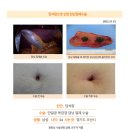 담석증수술후기. 상복부 통증이 있어 위내시경을 해도 이상이 없다고 계속 위장약만 먹었습니다. 건강검진에 돌이 있다고 담석 때문... 이미지