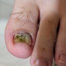 레푸스앤스타일 일산장항점 | 일산 발톱무좀 멍든 발톱 동시에 관리받고 좋아진 후기