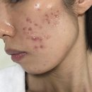 (주)아비브 | 아비브 어성초 에센스 후기 붉은기+여드름 같이 잡은 루틴