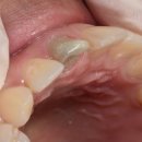 푸른치과기공소 | 앞니 1개 지르코니아 크라운 불투명,탁한색조 맞추기 싱글크라운