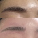 강남-147 | 강남 눈썹문신제거 후기 미작뷰티 강남본점 붉은눈썹제거 후기