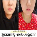 가야한의원 | 부산 서면 한의원 온다리프팅 이중턱 1회차 시술 후기