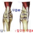 Re:슬개골 탈구 이미지