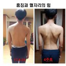 당뇨병 치료하는 침술이야기