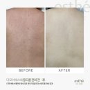 부산 서면 등드름 더모어뷰티에서 자신감 찾고 온 후기