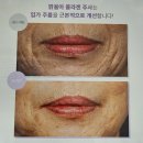 서울새로운피부과 | [자가진피재생술 팔자주름 후기]가격, 효과, 유지기간, 통증! 노원피부과