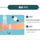 화상입었을때 응급처치 3가지 방법과 주의사항을 알아보자 이미지