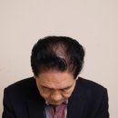 도트락 수원직영점 | 정수리커버 도트락 수원직영점 숱보강 두피 채우는 시술