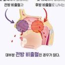 코피가 자주 나는 이유 원인 잦은 코피 멈추는법 이미지