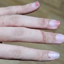 부산송정 | 부산 송정 서핑 해파리 쏘인 후기