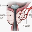 전립선으로 가는 혈류 막아 비대증 치료 이미지