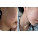 11305-15-600-1 | 올타이트리프팅 추천 신사역피부과 600샷 전후 비교 후기