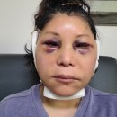유진성형외과의원 | 59세 안면거상 이마 거상 하안검 리얼 후기/원더풀 성형외과