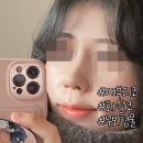 다듬성형외과의원 | 매부리코교정, 남자처럼 보인다는말 사라진 이유