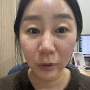 미추홀성형외과의원 | 인천 쌍꺼풀재수술+뒤트임+밑트임 후기