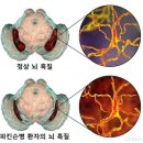 의료법인서강의료재단 서강병원 | 서강병원 물리치료 : 파킨슨병