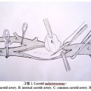 허혈성 뇌혈관 질환 (Ischemic Cerebrovascular Disease)의 수술적 치료 홍승철 교수님 이미지