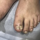 부산내성발톱 야무진 원장님 관리 후기