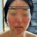 재생한의원 | 심부재생치료 방법과 한의원 비용 가격 공유합니다