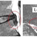살라딘 님의 요추디스크 L4-5의 MRI사진판독입니다. [4급 판정] 이미지