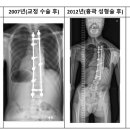 척추측만증 교정수술 &amp; 흉곽성형술 후기 입니다. 이미지