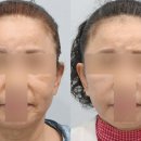 얼굴 처짐, 근본부터 해결하자! 안면 목거상 실제 변화