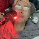 덜아픈세상레이저의료기 | 티타늄리프팅 + 제네시스레이저 +LDM 꿀조합 효과 통증 솔직후기