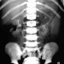 골화석증 (Osteopetrosis) 이미지