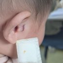 지디에스성형외과 | 스킨텍(부이개) 제거한 후기 / 167일차 5개월 아기 / 서울 지디에스성형외과
