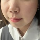 헤어도시압구정 | 압구정 피부과 쥬베룩스킨 효과 통증 무통주사 케뉼라 후기