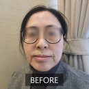 대박2 | 결혼식 혼주 미용 엄마 얼굴리프팅 청담피부과 소프웨이브 온웨이브 2회차 대박 효과 후기