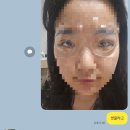 디에이치성형외과 | 강남ㅇㅇㅂ 성형외과 쌍수재수술 후기 (수술 후 7일)