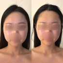 민레스트 | 대구남구에스테틱 민레스트 대구윤곽관리 얼굴맞춤관리 받은 후기