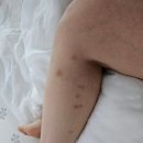 [양산 하지정맥류] 연대항외과 수술 후기, 1박2일 입원, 20대 하지정맥류 (병원 홍보 아님)