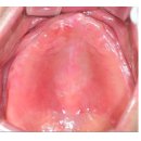김주형치과의원 | "틀니가 작아서 잘 빠지고 씹기 힘들어요" - 그 후의 이야기