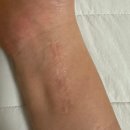 요골 | 손목 요골 골절 플레이트 삽입 및 제거 수술 과정, 퇴원, 제거 후기